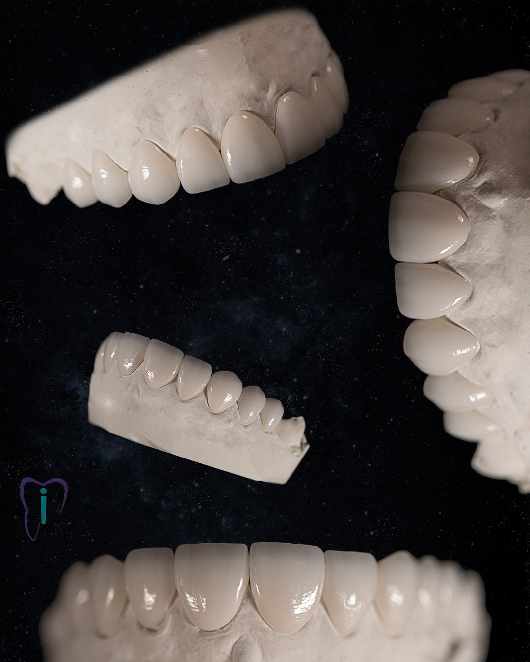 Carillas dentales